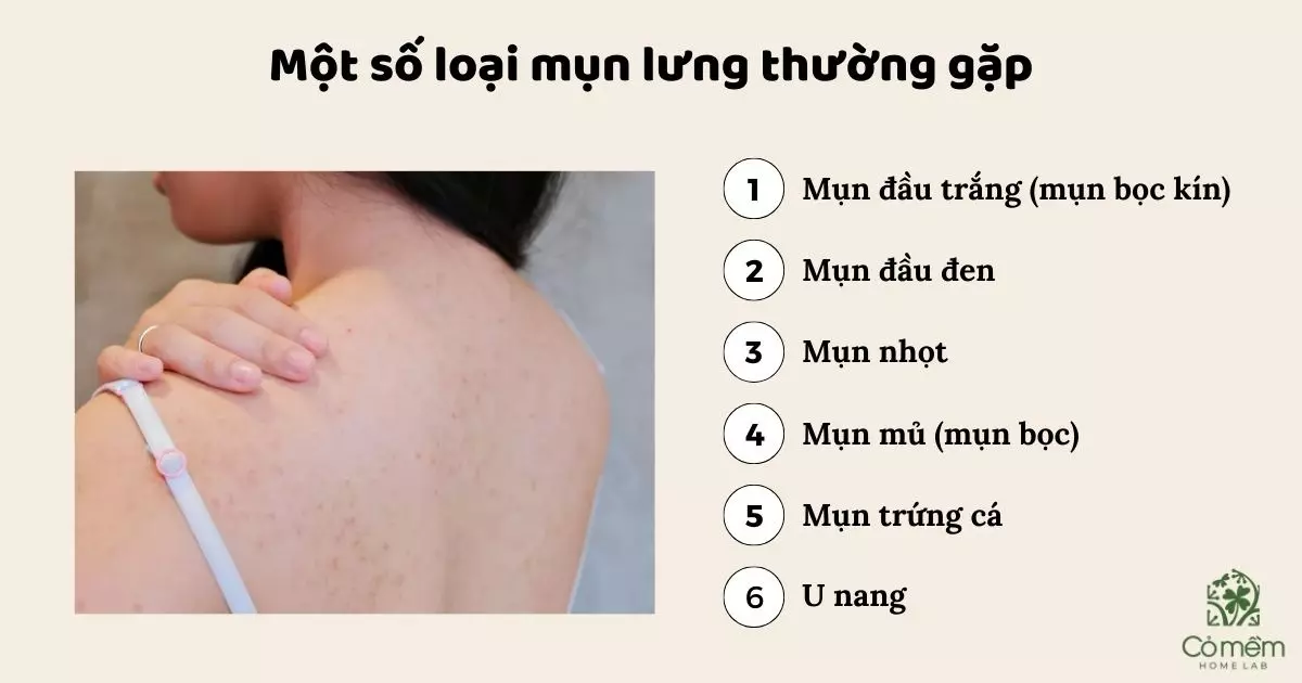 Giải đáp thắc mắc thường gặp về trị mụn lưng